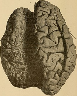split brain surgery brain myths