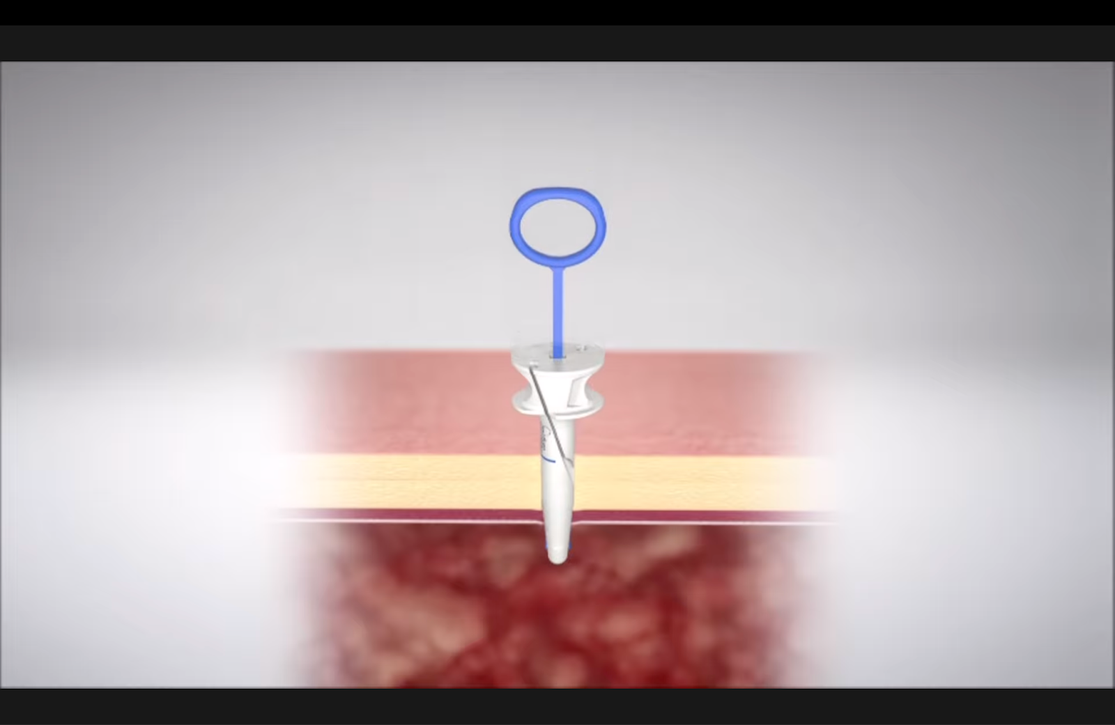 Suture Ease's CrossBow product.