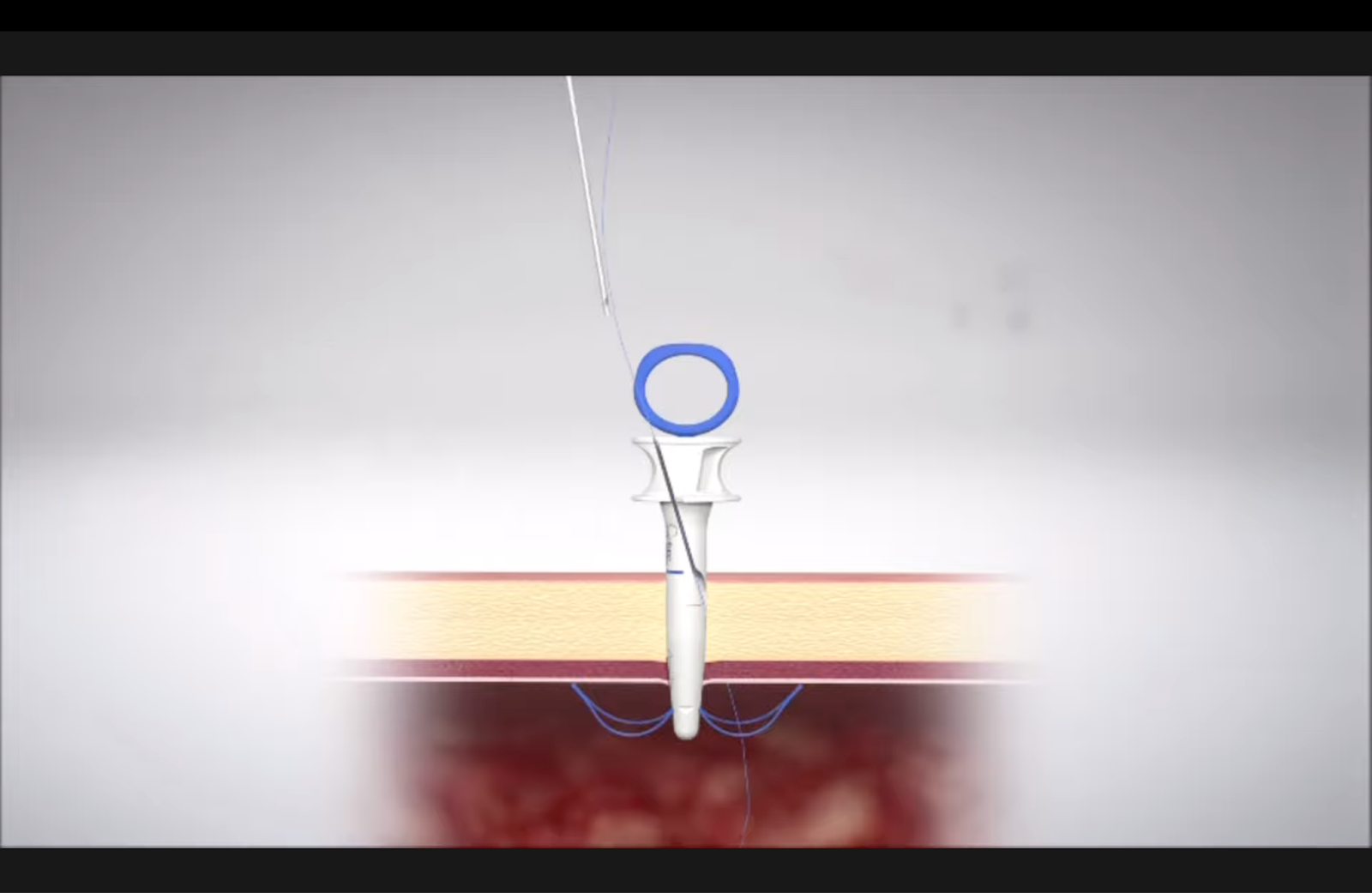 Suture Ease's CrossBow product.