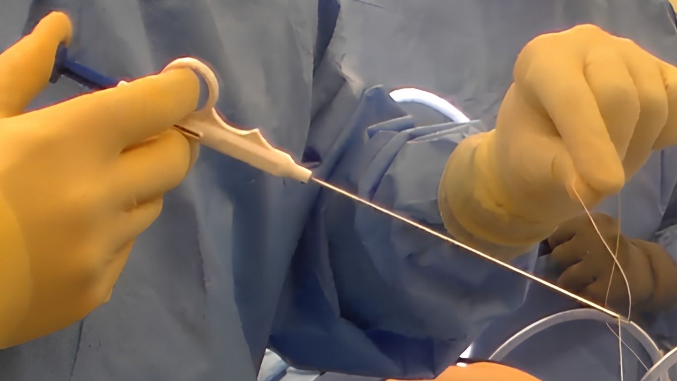 Gloved surgeon using a suture passer system during laparoscopic closure
