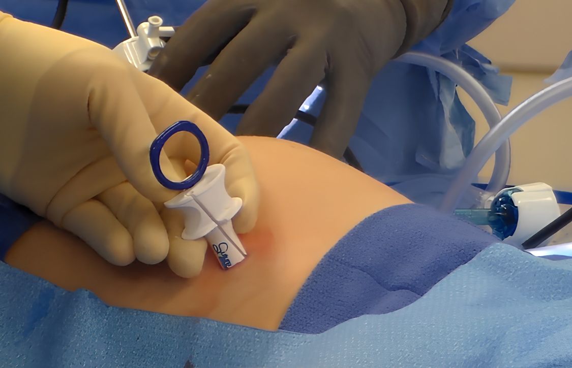 fascial suture technique done by a surgeon