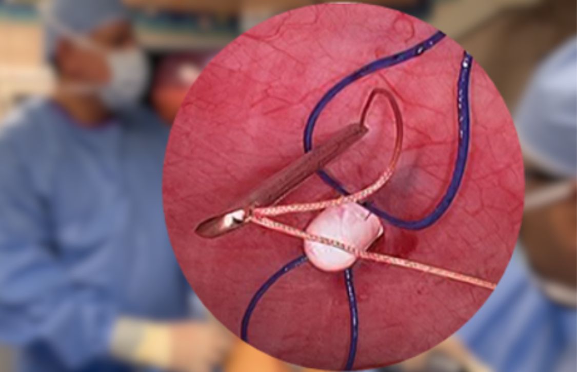 intra-abdominal view showing closure in progress incisional hernia risk