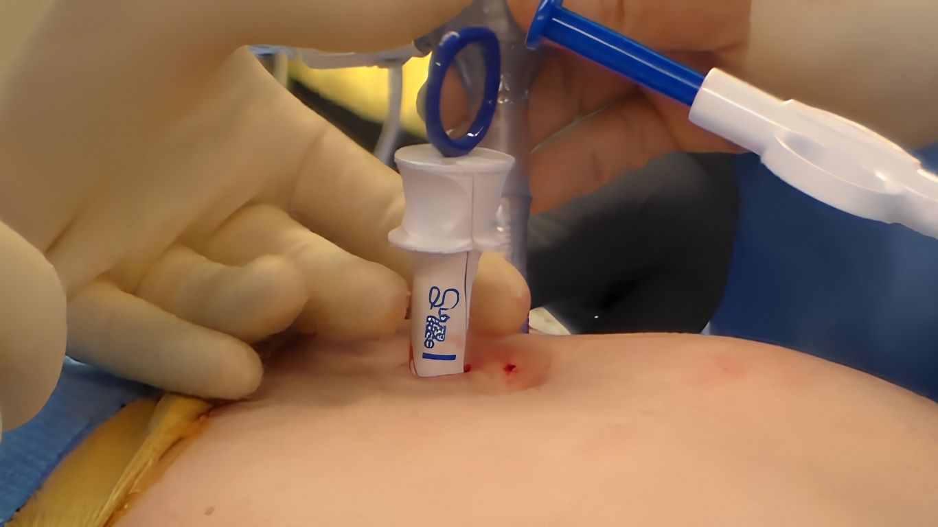 A surgeon saving time with a crossbow fascial closure system