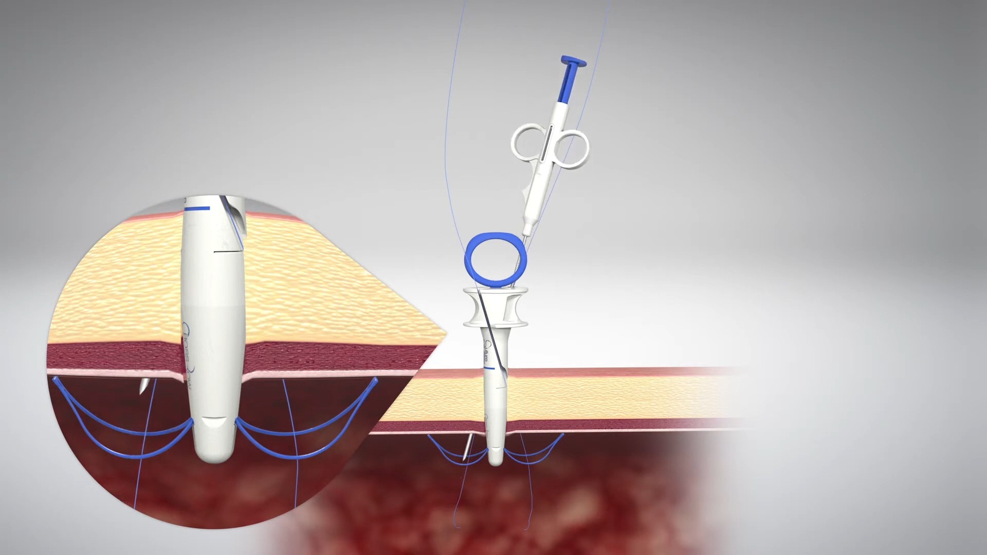 suture ease system closing trocar sites
