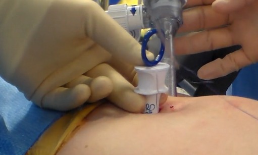 suture passer device