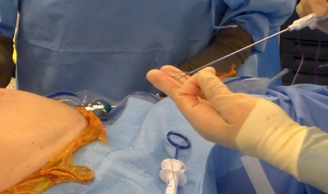 a surgeon using a laparoscopic trocar system