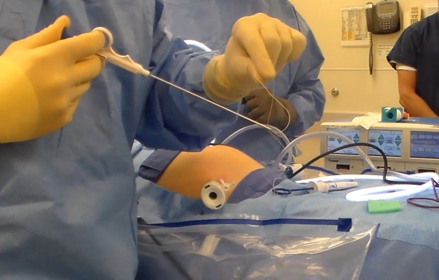 a fascial closure in process