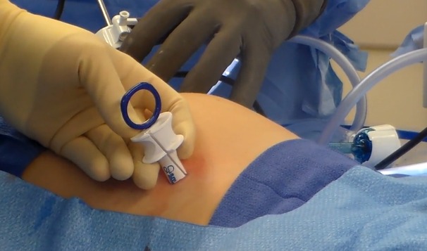 a surgeon suing a Surgical Fascial Closure device