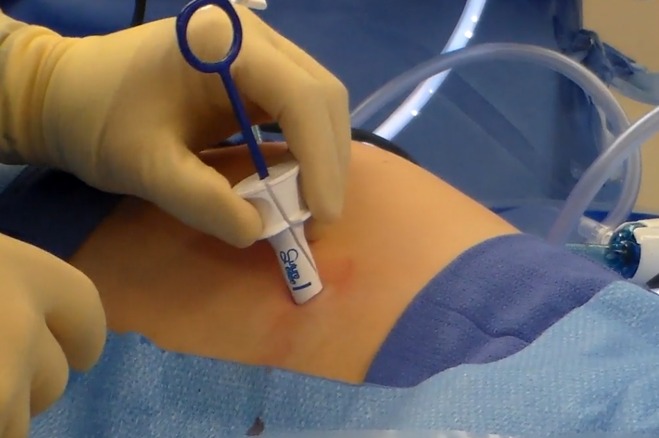 suture ease crossbow device for a standardize suture passer system