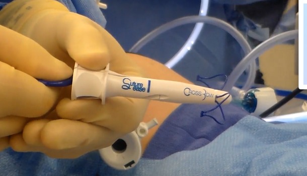 laparoscopic knot pusher by suture ease