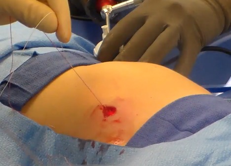 a surgeon doing a laparoscopic closure system