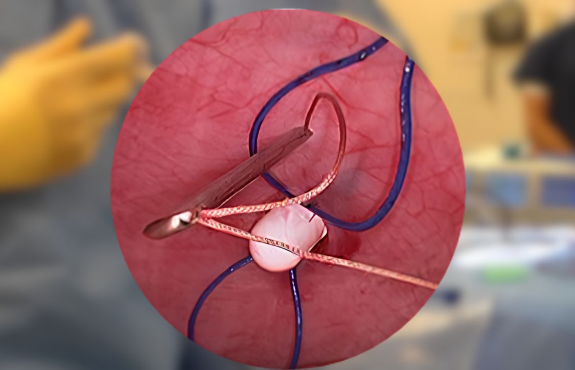 intra-abdominal view of fascial suture technique stitch