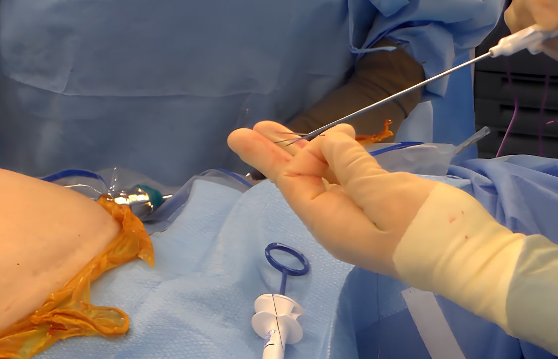 surgeon completing suture tie during procedure using carter thomason replacement