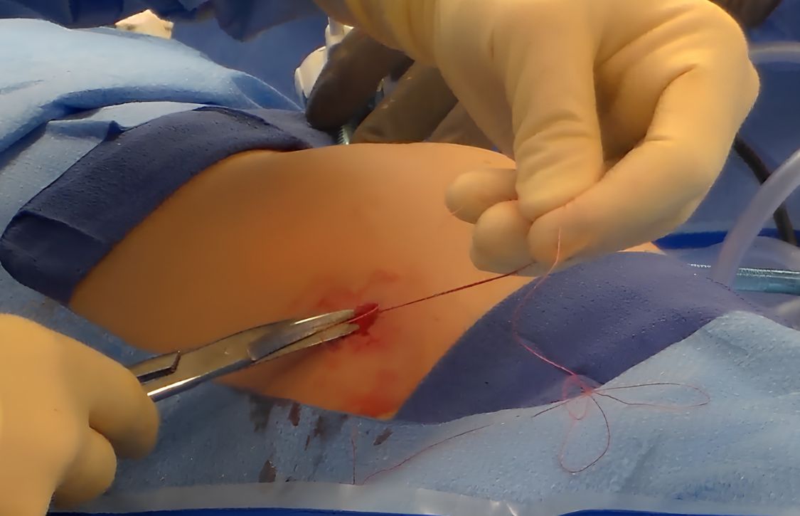 closure site post-procedure without trocar site complications