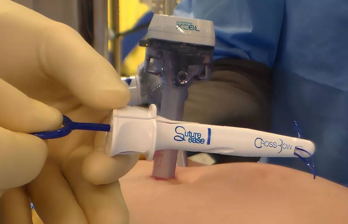 suture ease crossbow replacing carter thomason devices in surgery