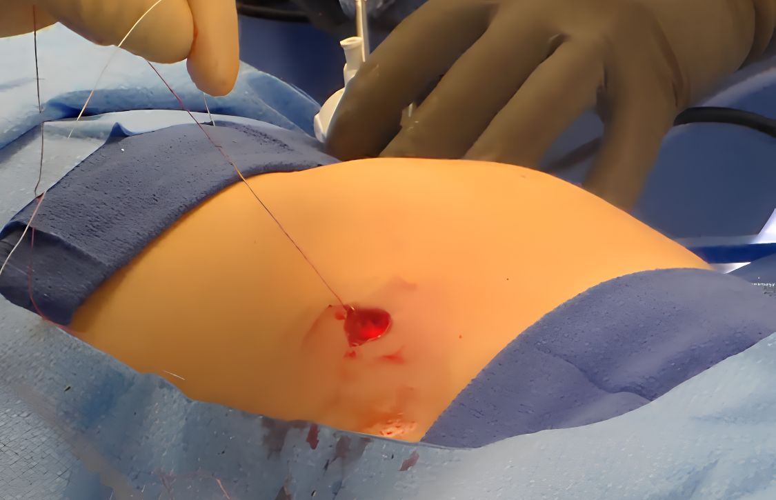 a large trocar defect being closed with suture during a port site hernia prevention procedure