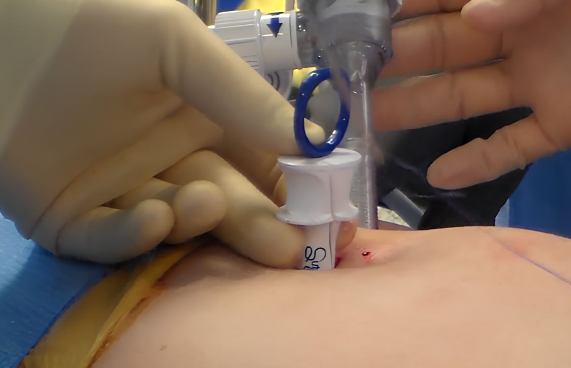 device securing wider defect port site hernia prevention