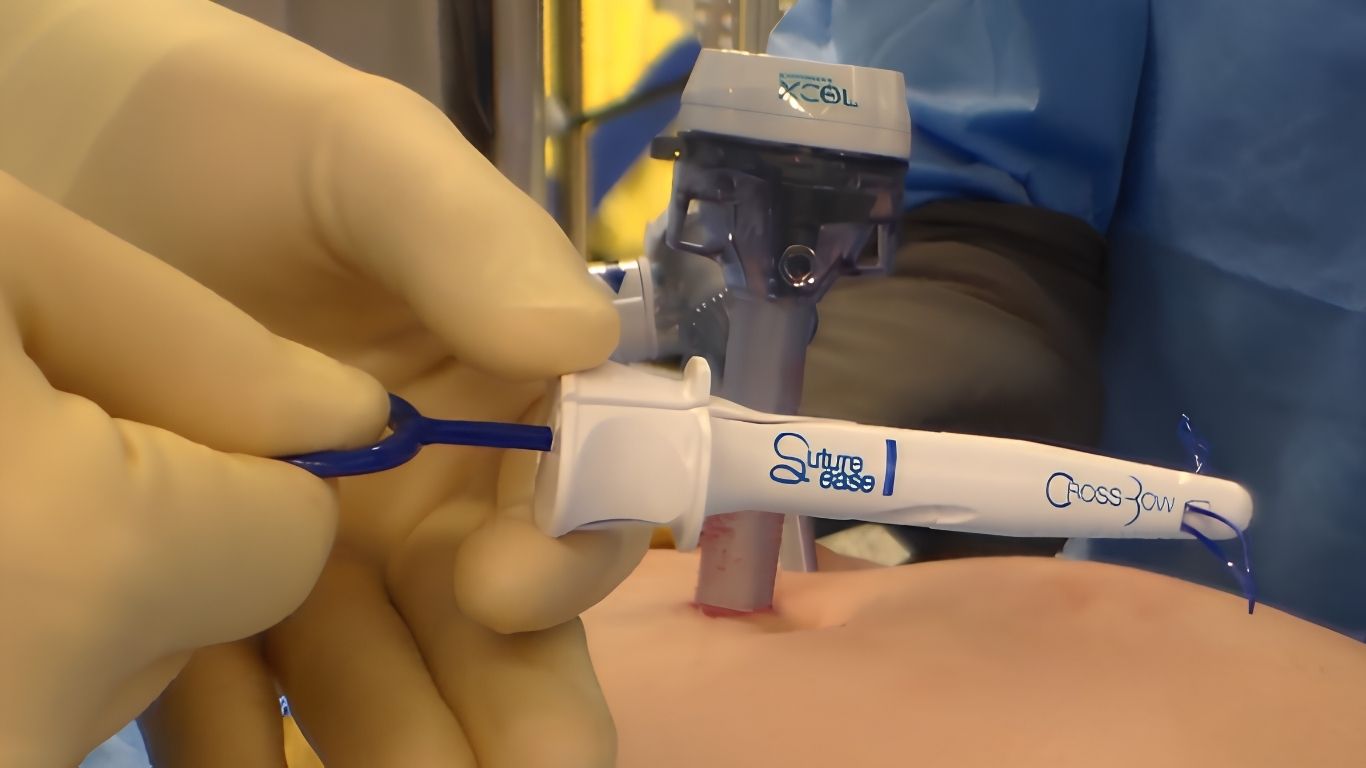 CrossBow device positioned for reproducible laparoscopic port site closure at a trocar site